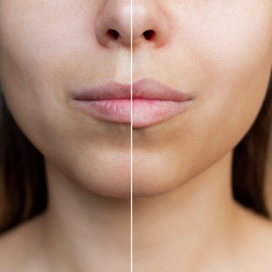 Remodelación labial