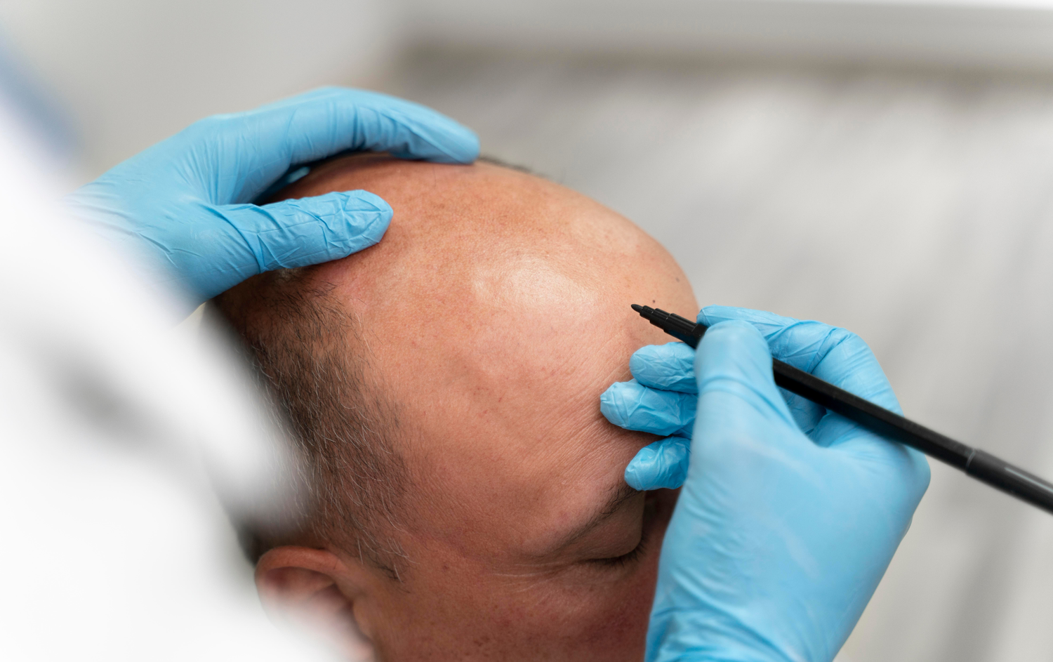 Implantación folicular individual en tratamiento FUE para recuperar densidad capilar