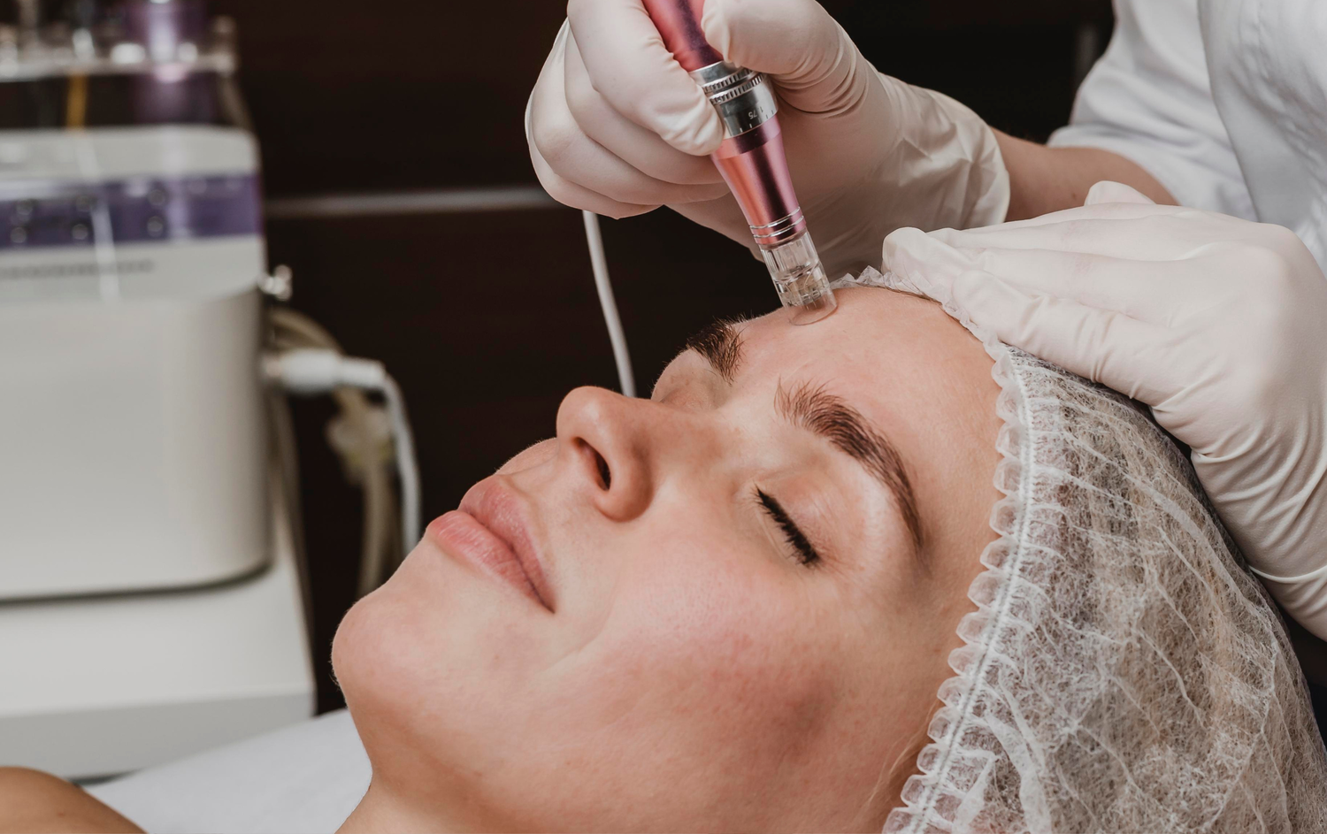 Microneedling facial en Orbe Clinics. Reduce cicatrices, manchas y arrugas. Resultados naturales y visibles desde las primeras sesiones. Clínicas en Elche y San Juan.