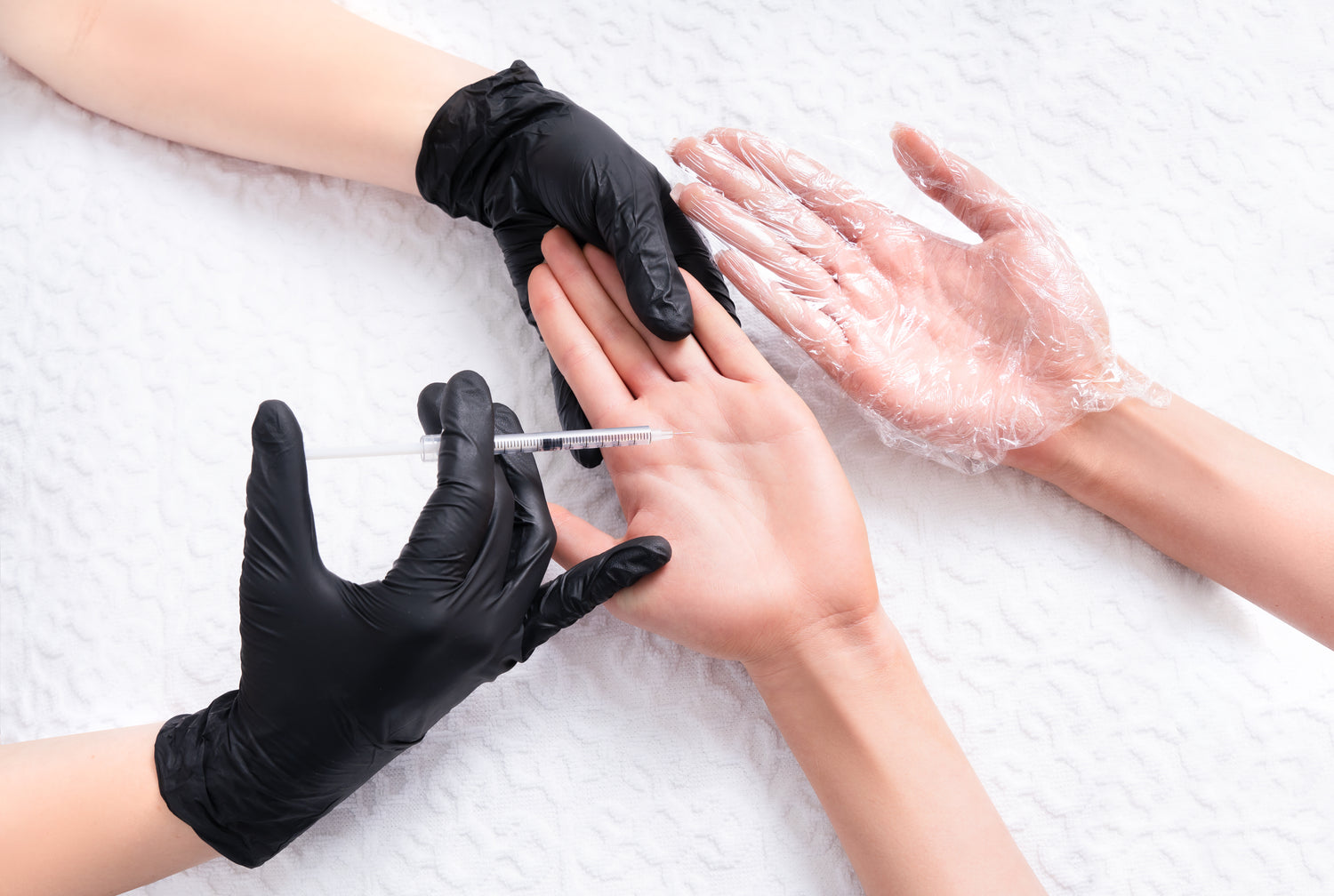 Aplicación médica de toxina botulínica para tratar la hiperhidrosis en axilas en Orbe Clinics Alicante.