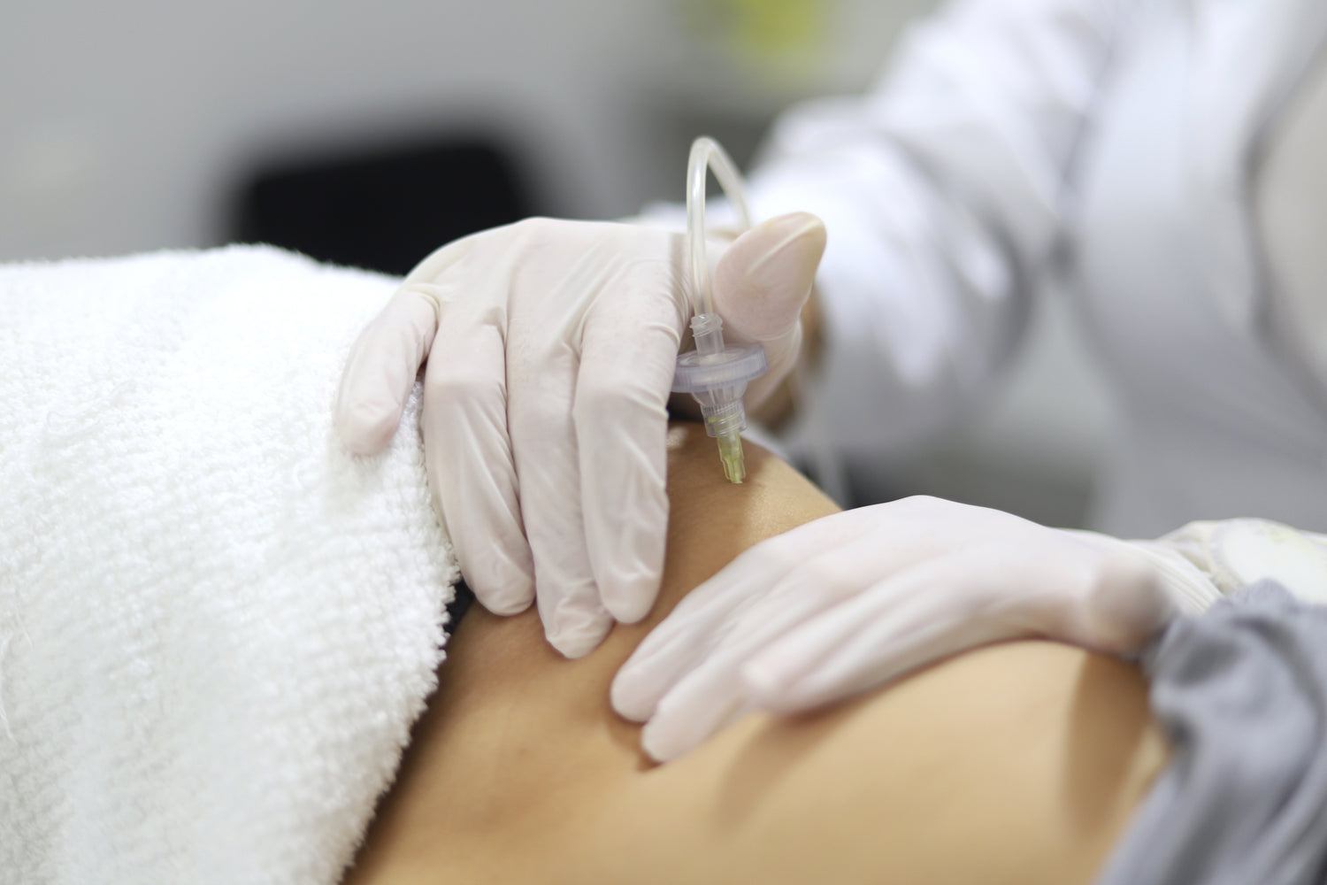 Tratamiento de carboxiterapia corporal en Orbe Clinics aplicado en piernas y abdomen para mejorar la celulitis, flacidez y tonicidad de la piel.