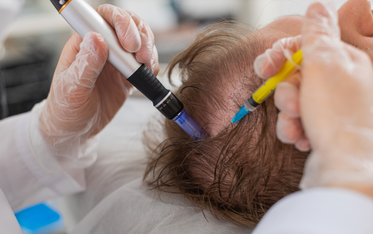 Aplicación de exosomas capilares en Orbe Clinics para frenar la caída y mejorar la densidad del cabello