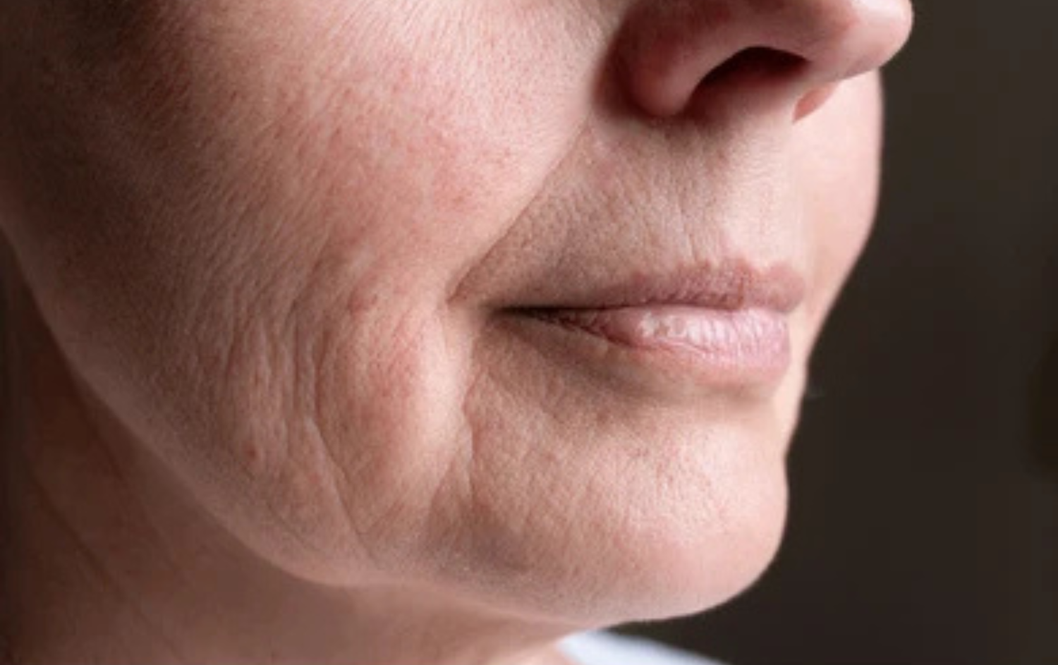 Tratamiento de microneedling facial antiaging para rejuvenecer la piel y reducir arrugas en Orbe Clinics