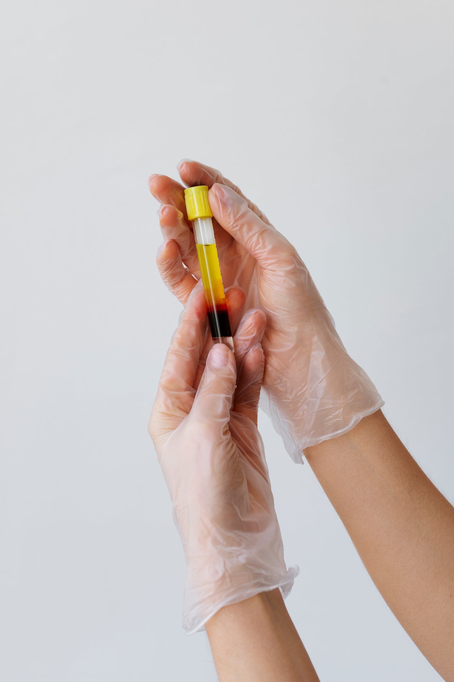 Procedimiento de plasma rico en plaquetas, en el que se utiliza la propia sangre del paciente para estimular la producción de colágeno y mejorar la calidad de la piel