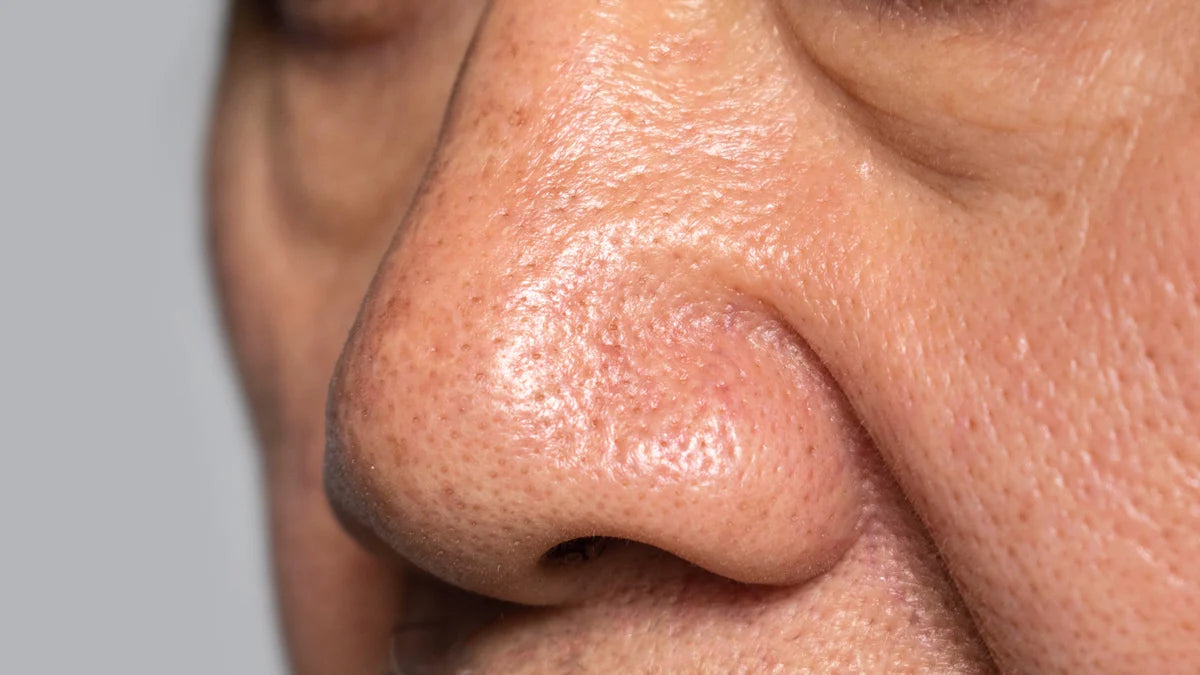 Microneedling para cerrar poros y mejorar la textura de la piel en clínica estética Orbe Clinics