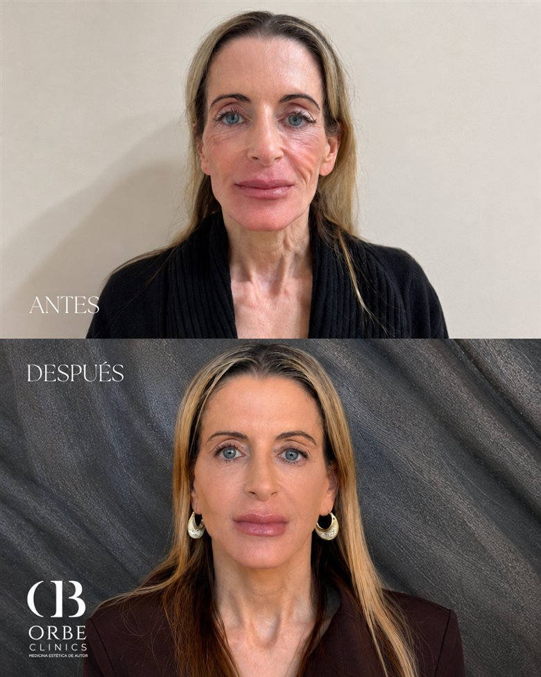 Antes y después de armonización facial · caso 1