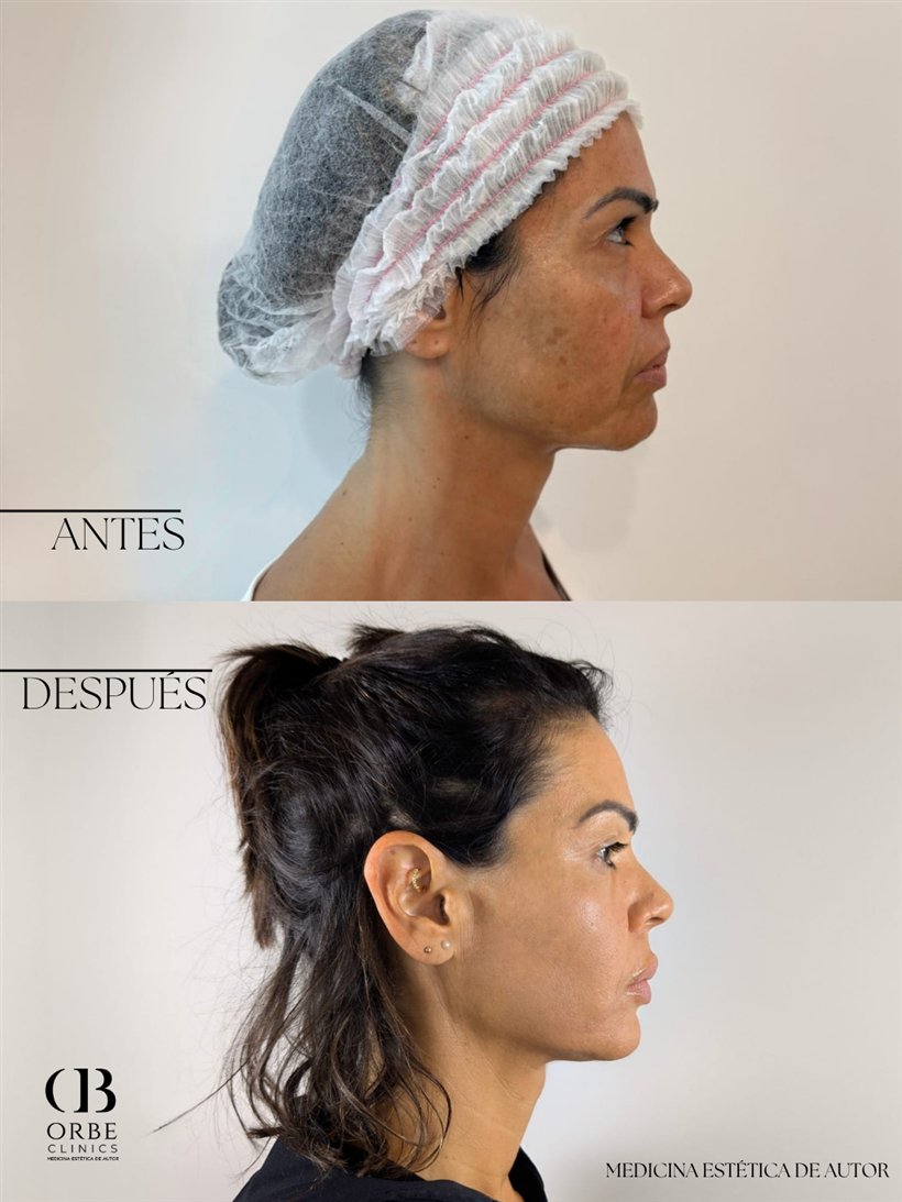 Antes y después de armonización facial · caso 2