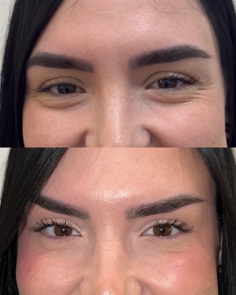 Antes y después de toxina botulínica · caso 1