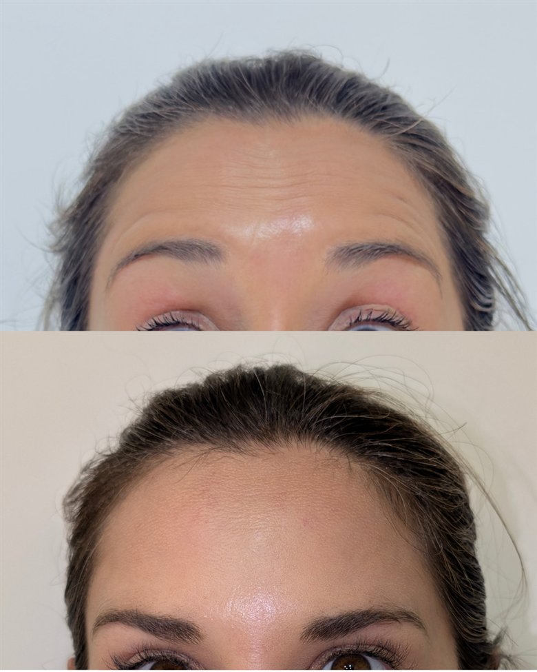 Antes y después de toxina botulínica · caso 2