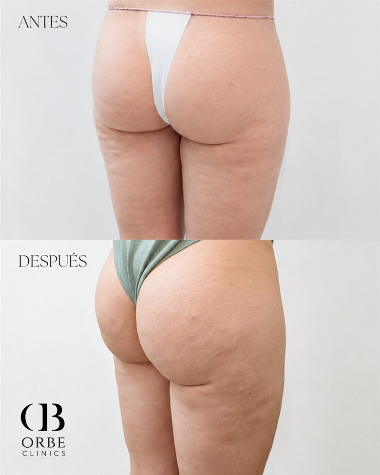 Antes y después corporal · caso 2