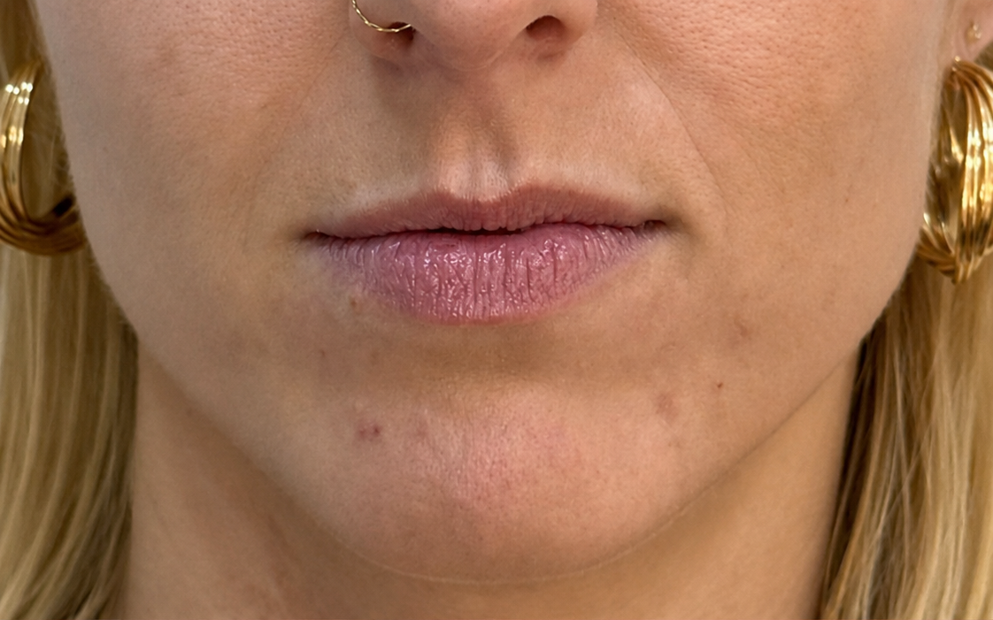 Antes del aumento de labios en Orbe Clinics