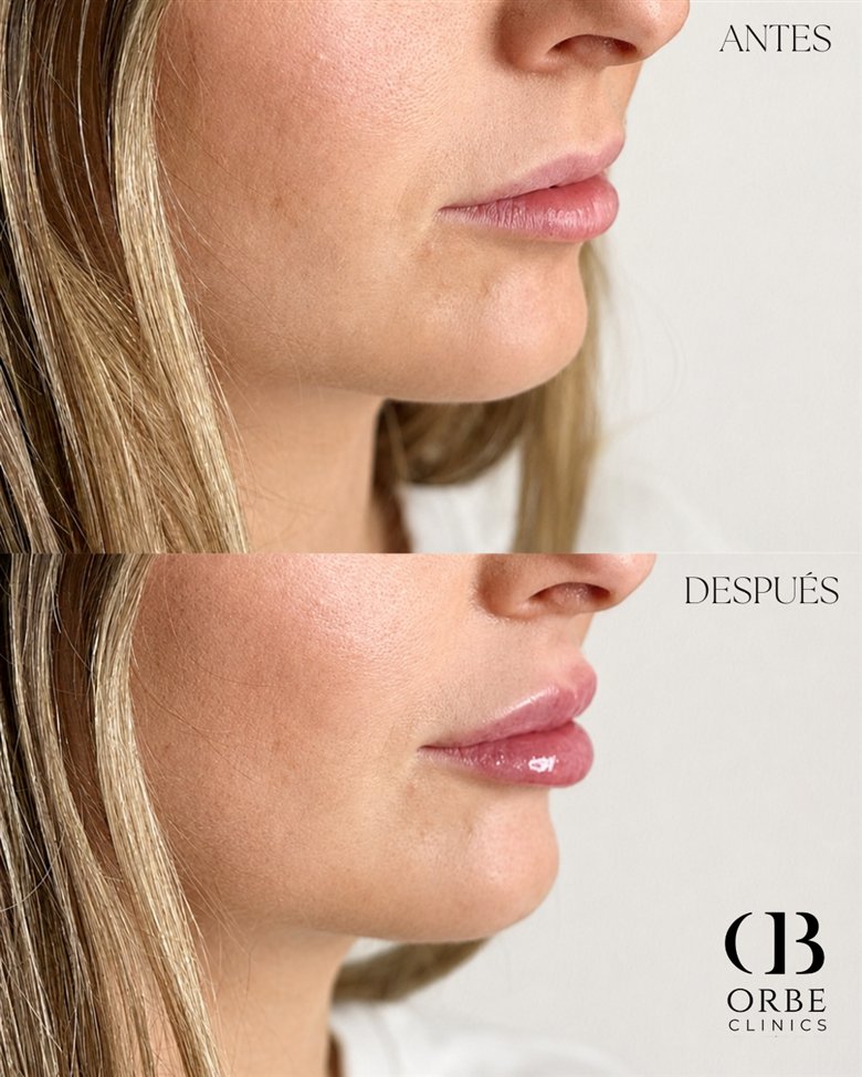 Antes y después de aumento de labios · caso 1