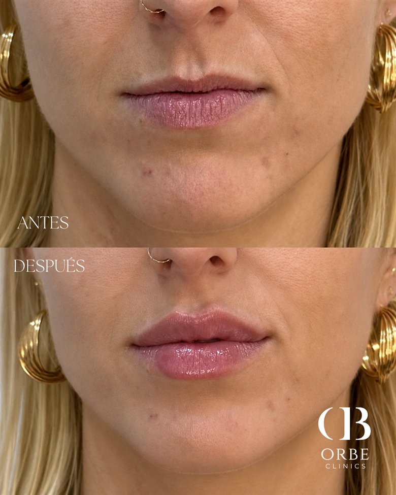 Antes y después de aumento de labios · caso 2