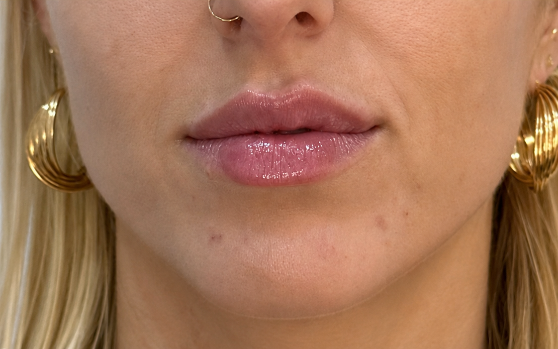 Después del aumento de labios en Orbe Clinics