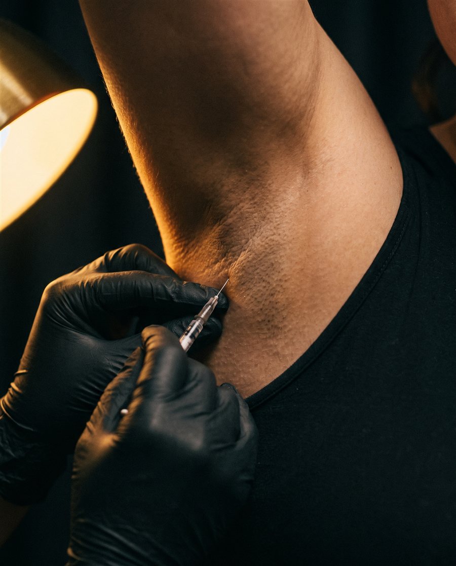 Toxina botulínica para la hiperhidrosis en Orbe Clinics