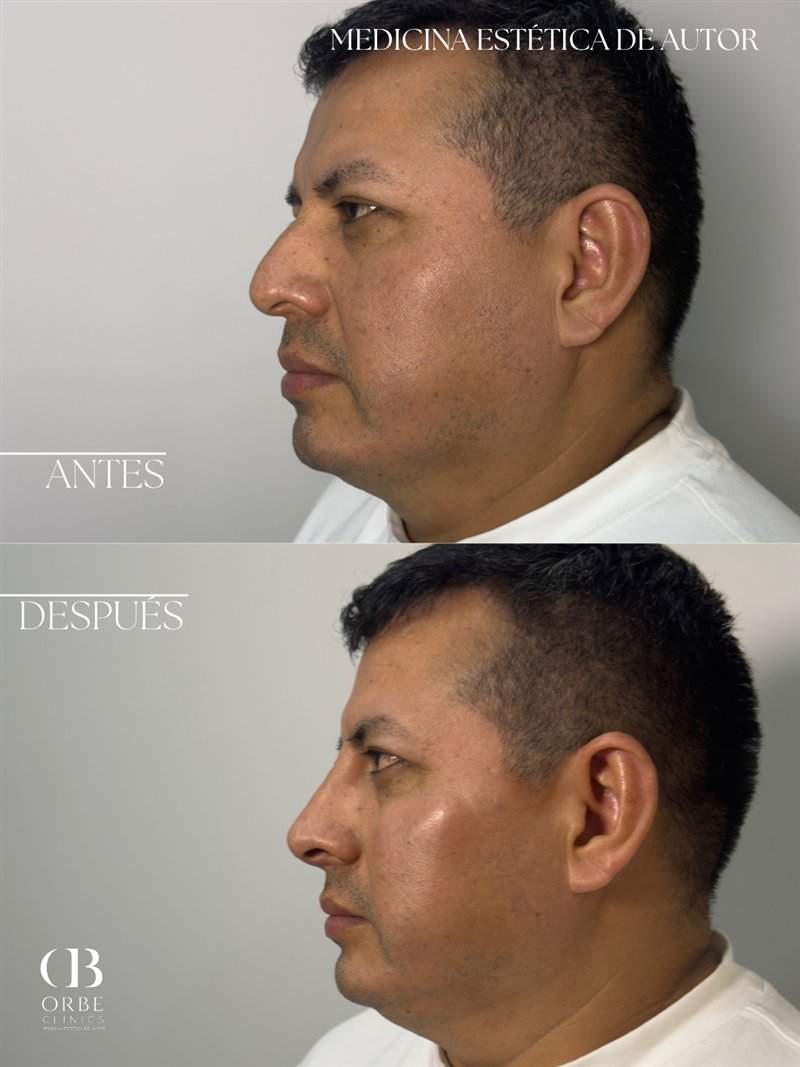 Antes y después de rinomodelación · caso 2